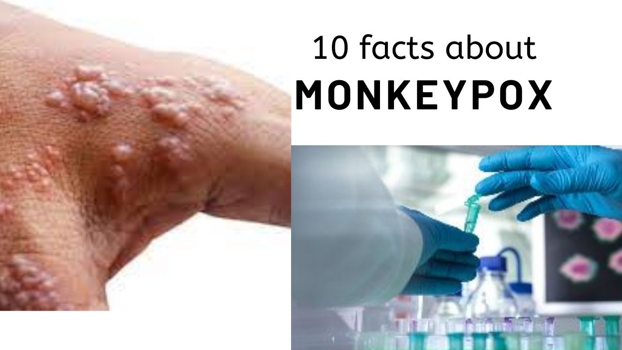 Monkeypox: 10 quick facts about the rapidly spreading disease in Europe & North America