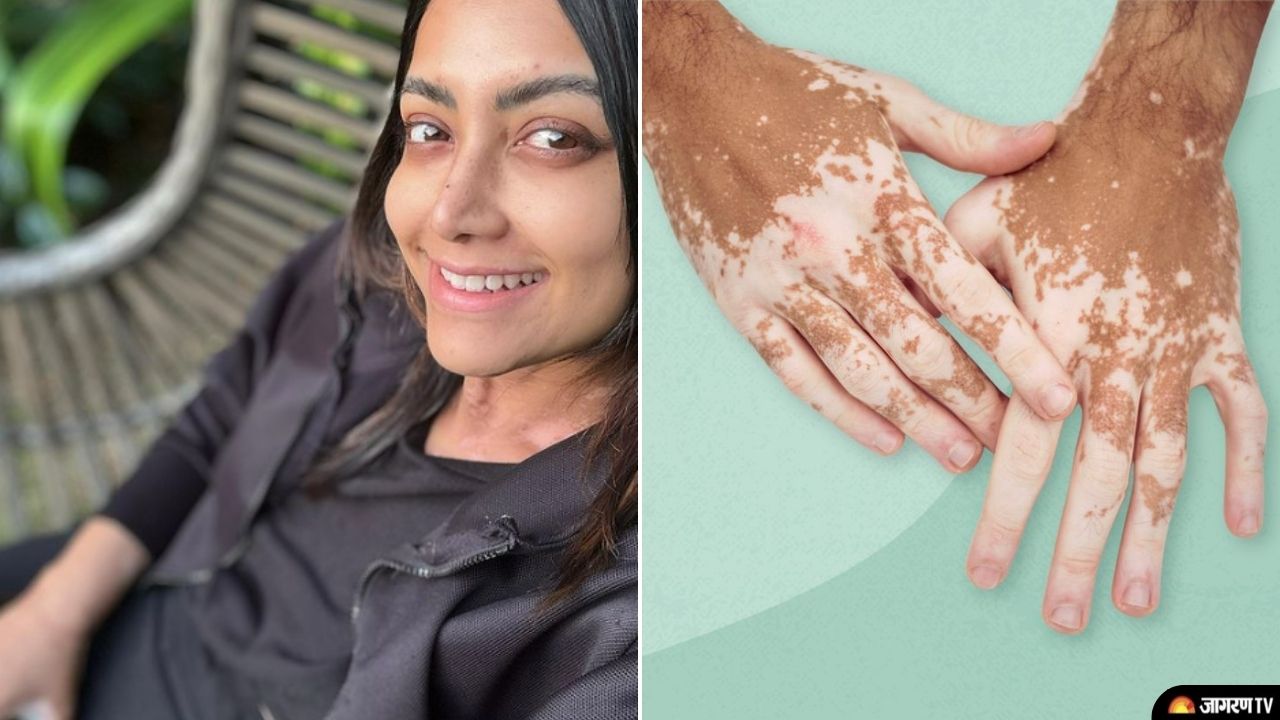 What Is Vitiligo South Actress Mamta Mohandas Diagnosed With This