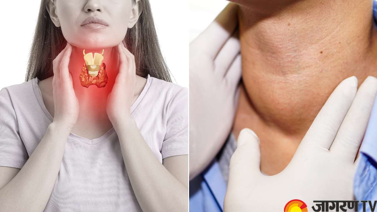 Understanding the Difference Between Thyroid and Goiter; Foods to Reduce Thyroid Nodules