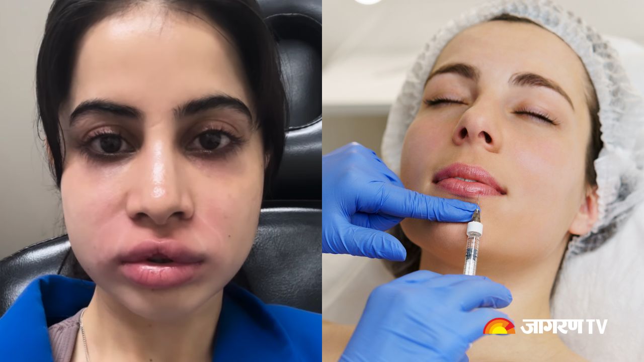 Uorfi Javed's Face Swells After Lip Filler Removal: Facial Fillers’ Risks, Benefits, and Who Should Get Them?