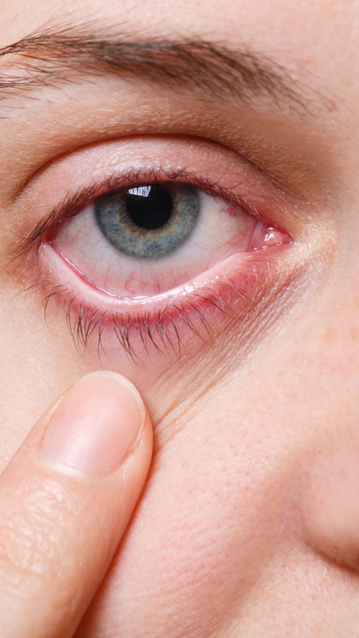 understanding-eye-flu-causes-types-symptoms-treatment-and-effective